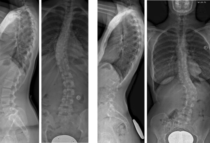 Recent research has shed more light on the role of heredity in scoliosis.
